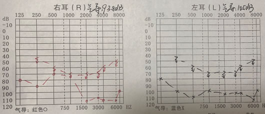 青年重度听力损失案例